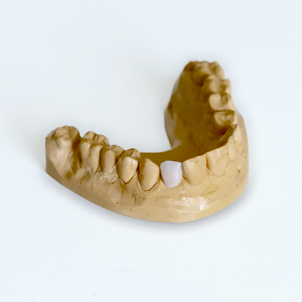 estetica dentale, ricostruzione in ceramica | La clinica dentale