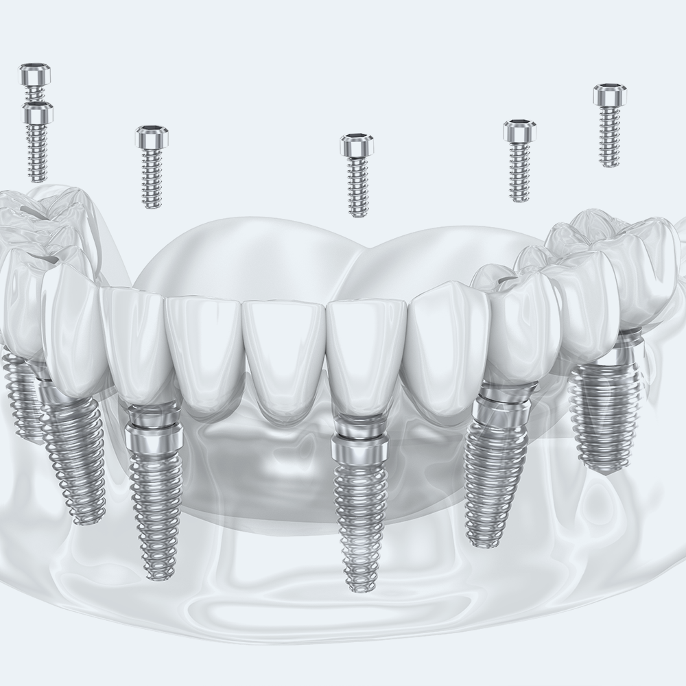 implantologia a carico immediato | La clinica dentale