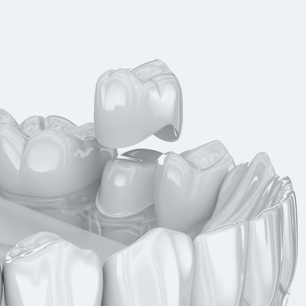 implantologia di una corona | La clinica dentale
