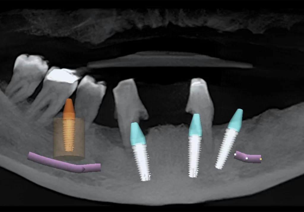 implantologia guidata | La clinica dentale
