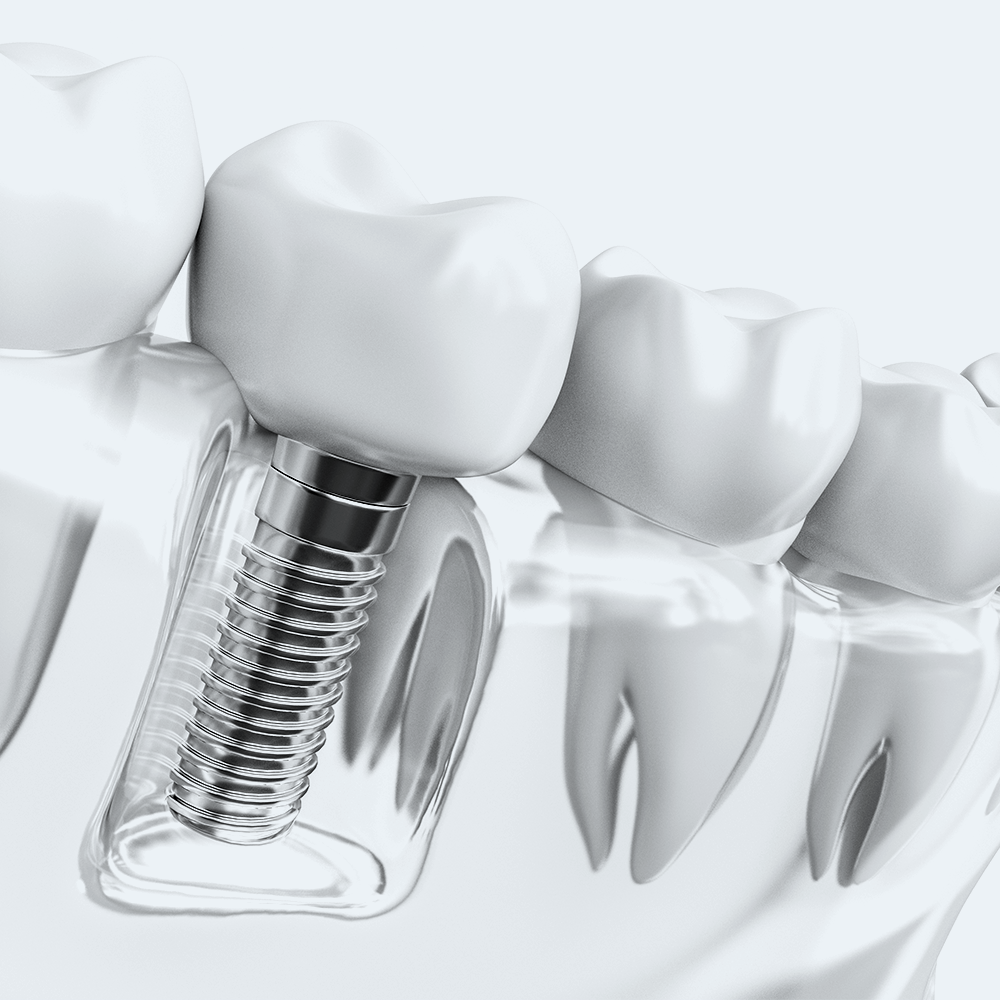 implantologia tradizionale | La clinica dentale