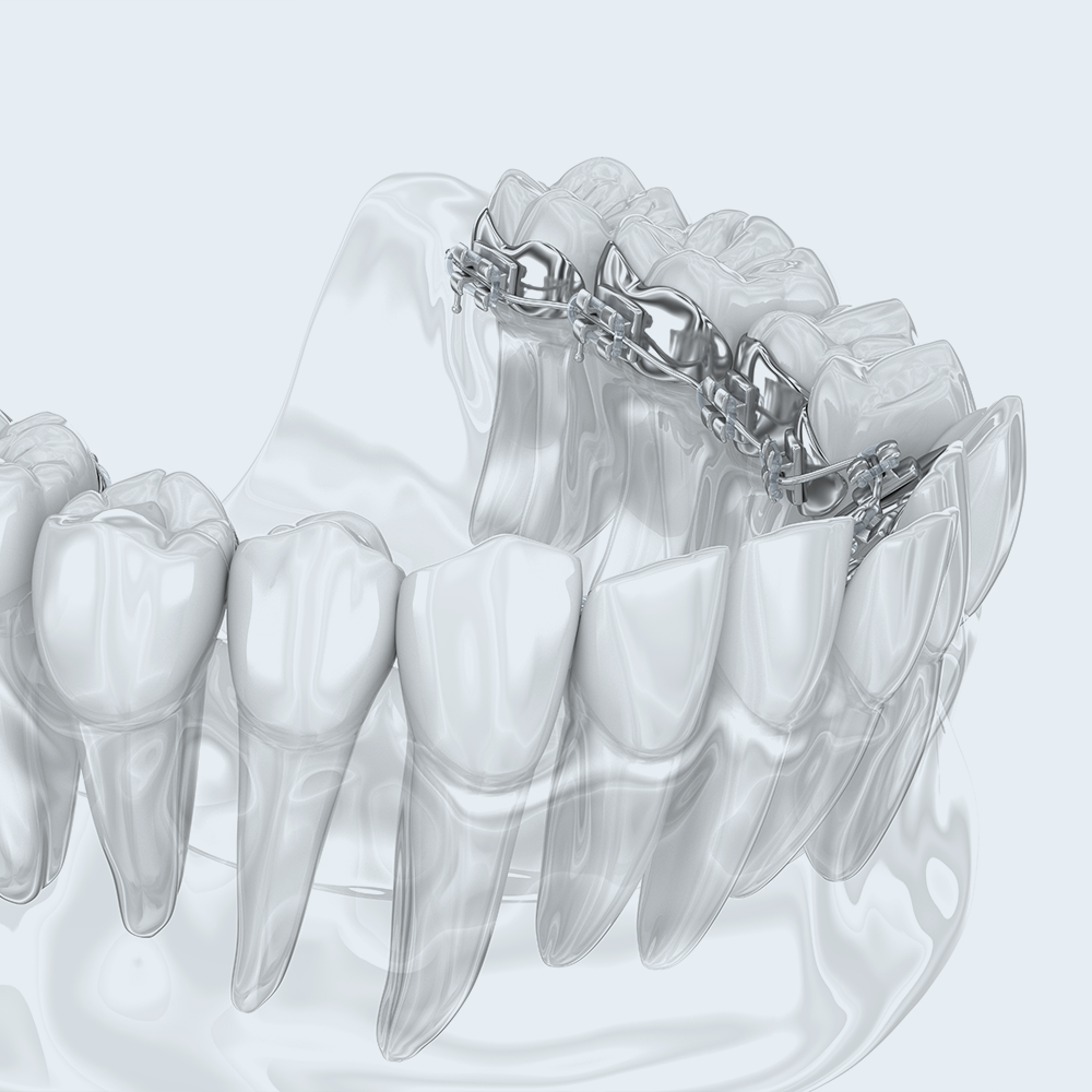 espansori senza attacchi | La clinica dentale