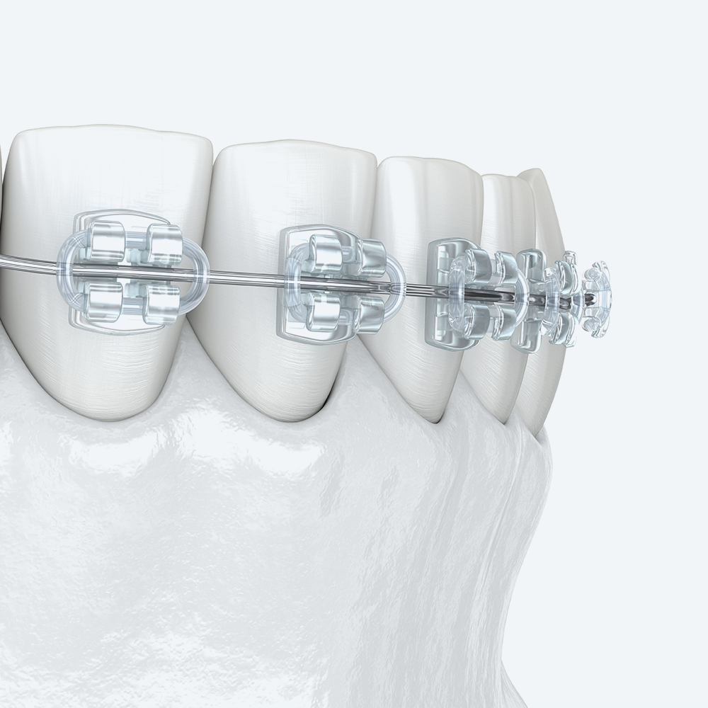 ortodonzia fissa | La clinica dentale