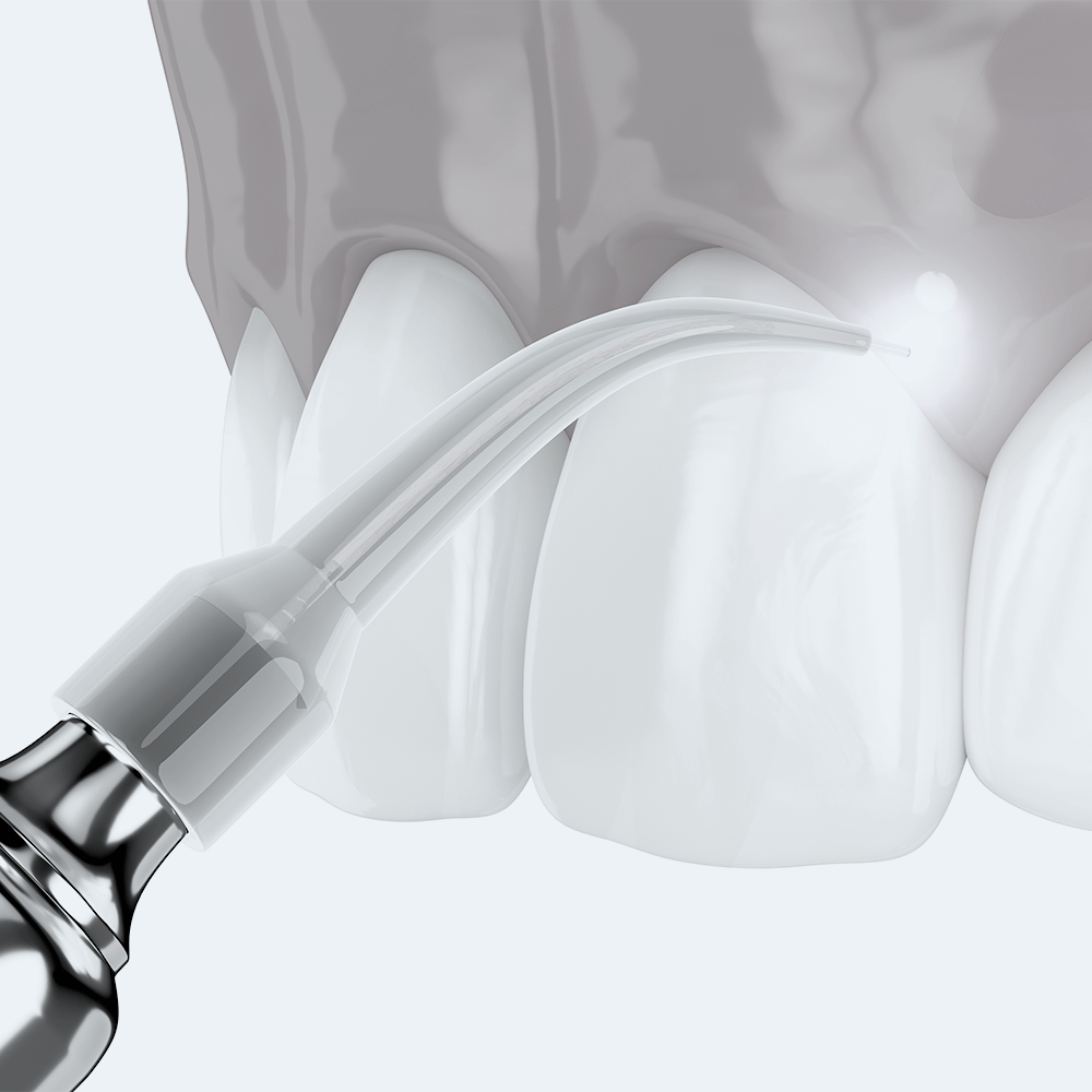 laser dentale | La clinica dentale